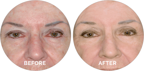 omnilux-red-light-anti-aging-therapy-before-and-after-in-darien-ct-at-versailles-medical-spa-thumbnail-1
